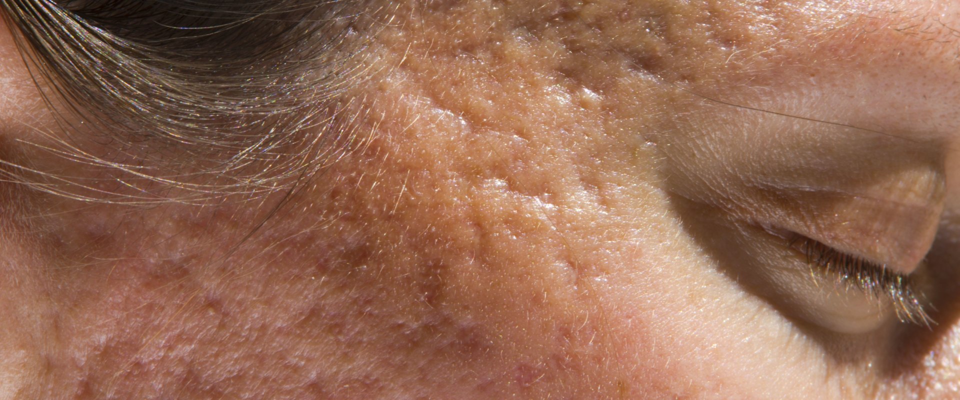 Can Botox Help Treat Acne?