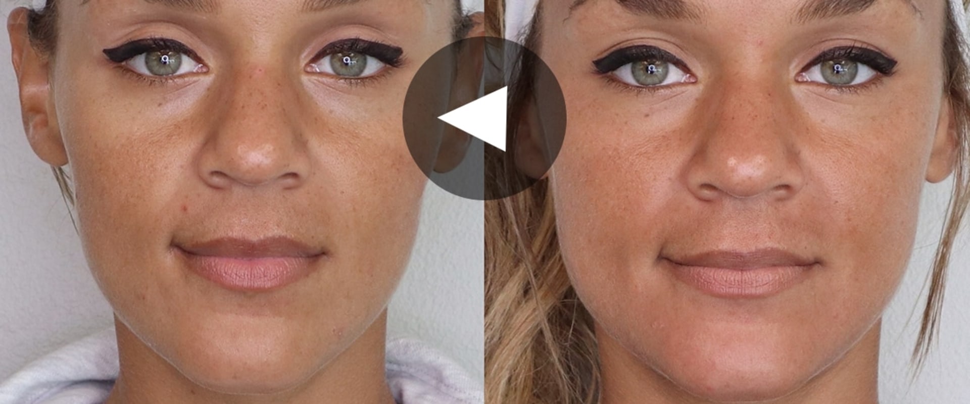Will Botox Raise My Eyebrows? A Non-Surgical Brow Lift Alternative