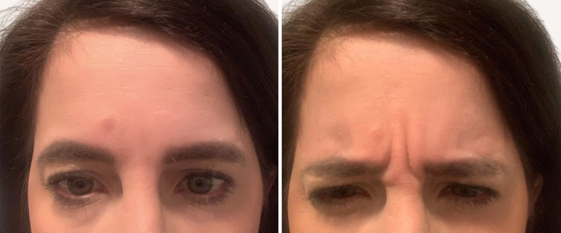 Where Does Botox Come From? An Expert's Perspective