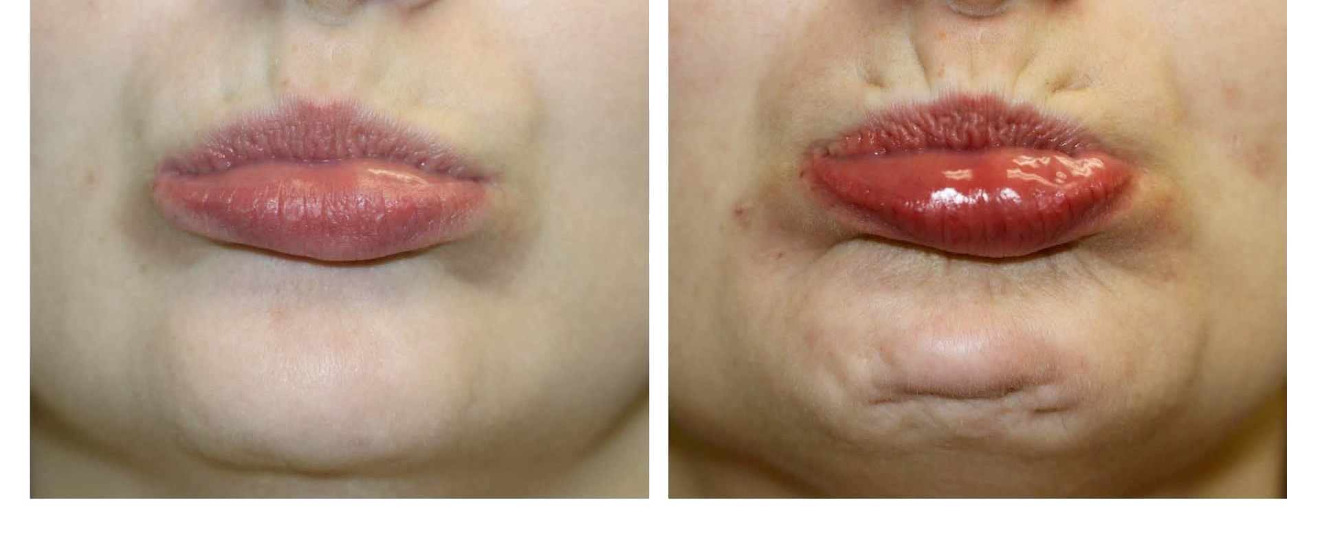 The Benefits of Botox Injections on the Chin