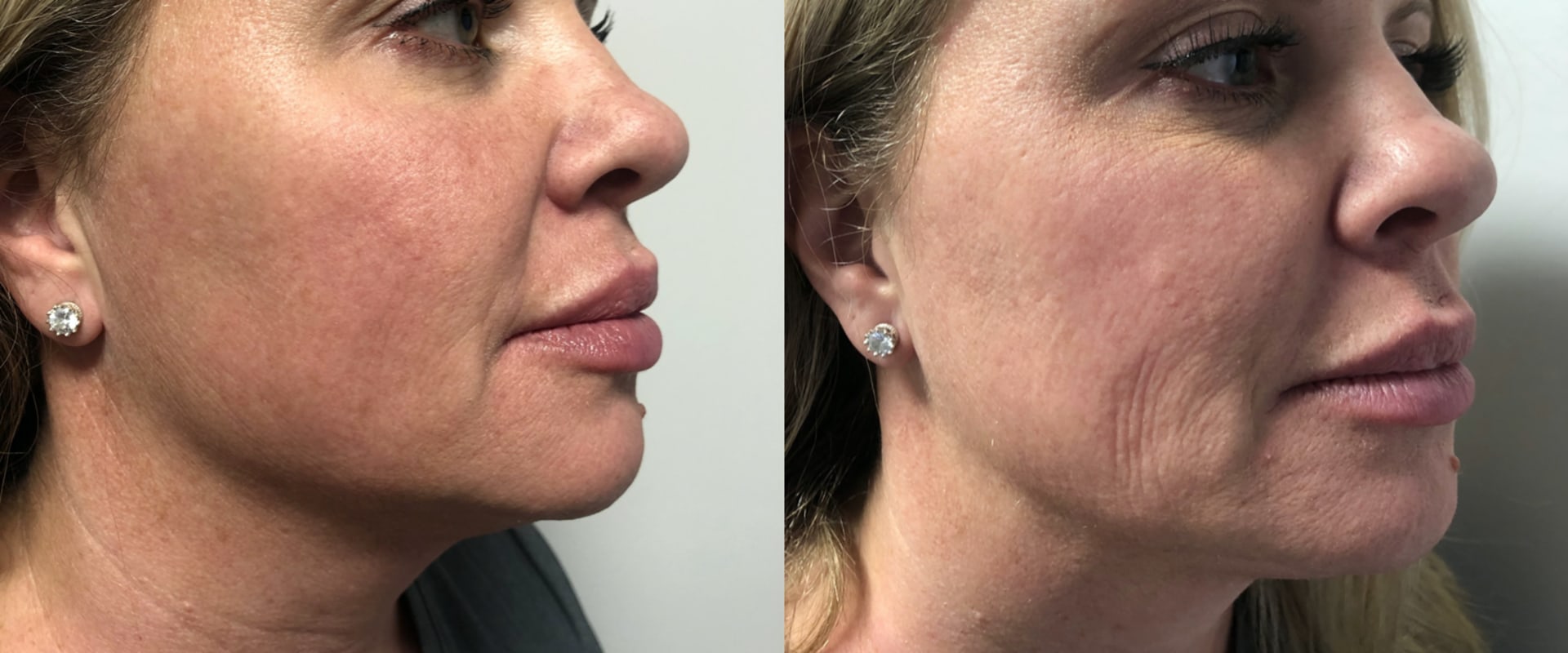 How Botox Prevents Wrinkles: An Expert's Guide