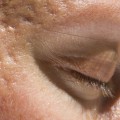 Can Botox Help Treat Acne?