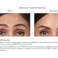 Botox and Fillers of Beverly Hills: Premium Botox Injections