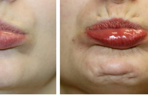 The Benefits of Botox Injections on the Chin
