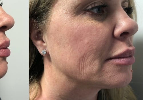 How Botox Prevents Wrinkles: An Expert's Guide